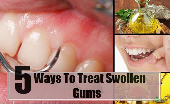 Swollen-Gums