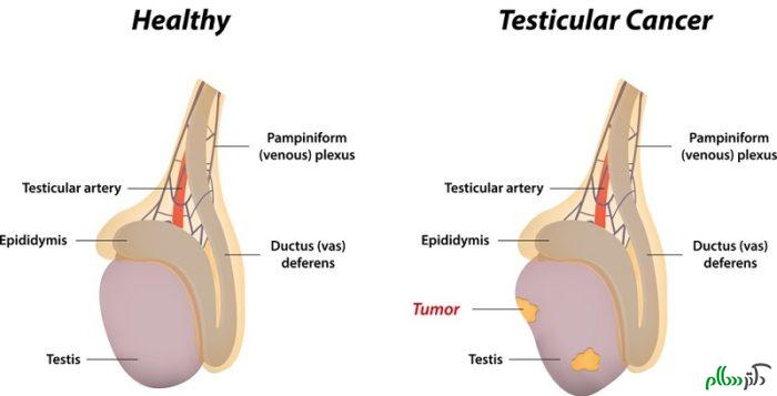Testicular-Cancer-700x357