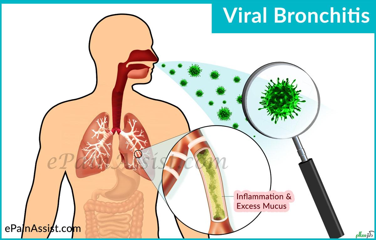 Viral-Bronchitis