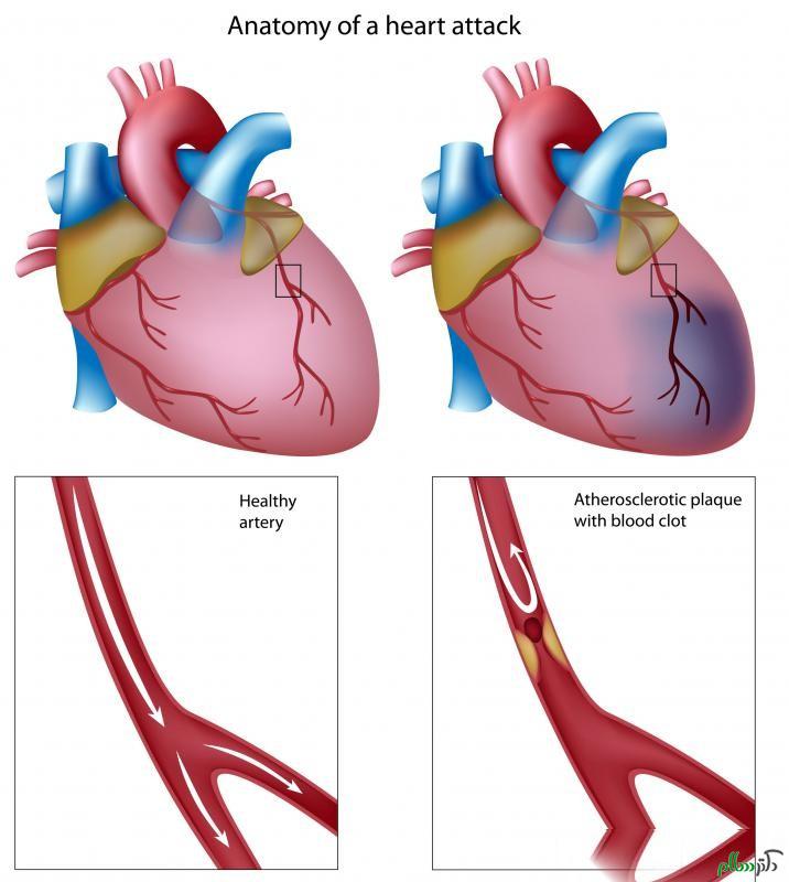 anatomy-of-a-heart-attack