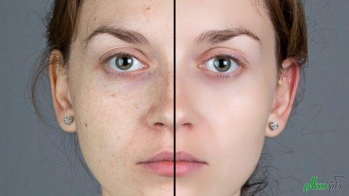 blemishes-on-your-face-500x281