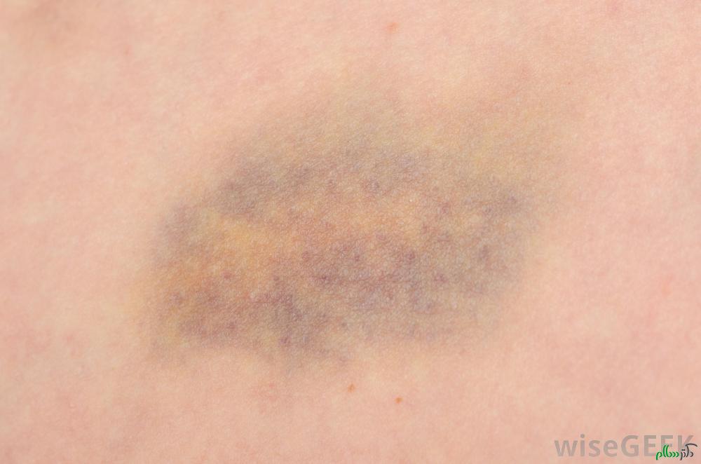 bruise-close-up