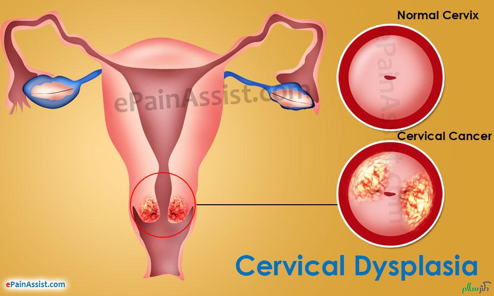 cervical-dysplasia