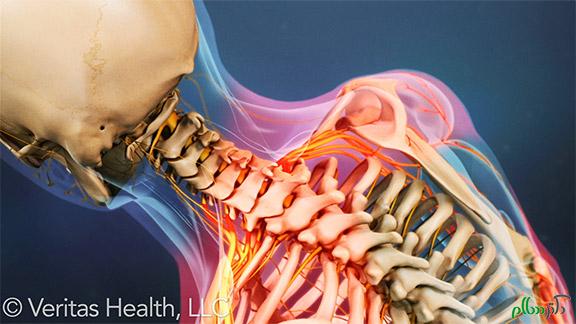 راه حل های درمانی برای مشکلات دیسک گردن . 1