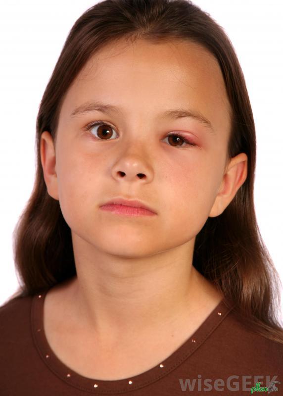 child-with-swollen-face-and-eye