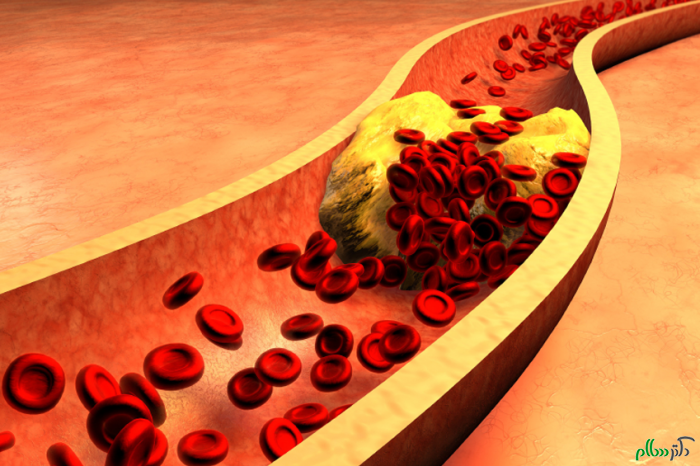 clogged-artery-with-platelets-and-cholesterol-plaque