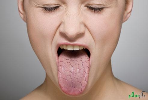 علائم و روش درمان خانگی خشکی دهان 
