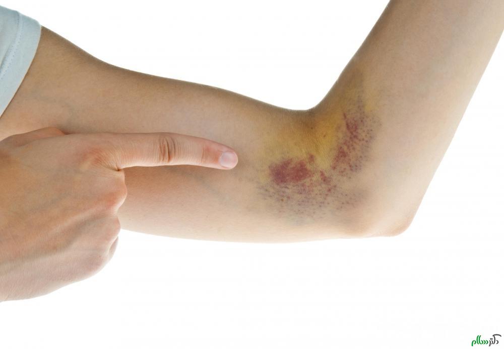 finger-pointing-to-hematoma-near-the-elbow