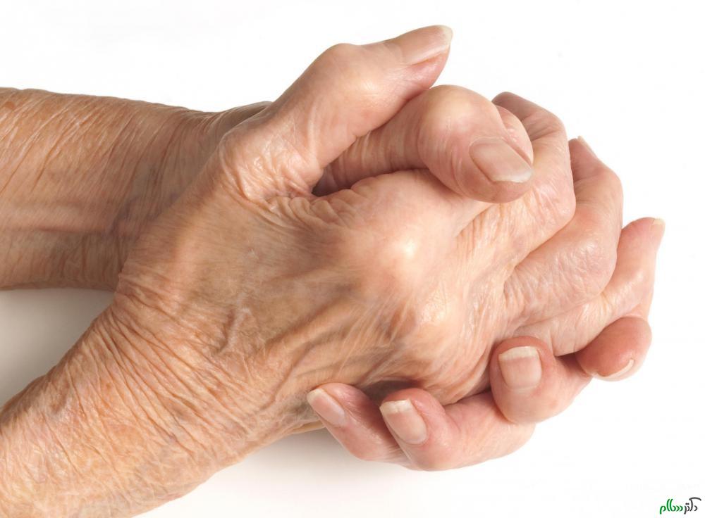 hands-of-woman-with-arthritis