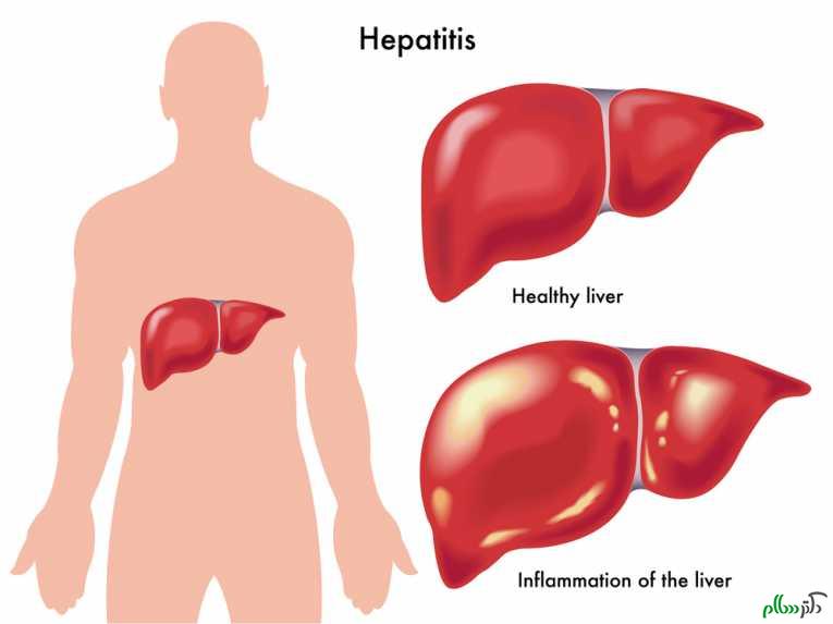 چقدر نسبت به هپاتیت آگاهی دارید؟