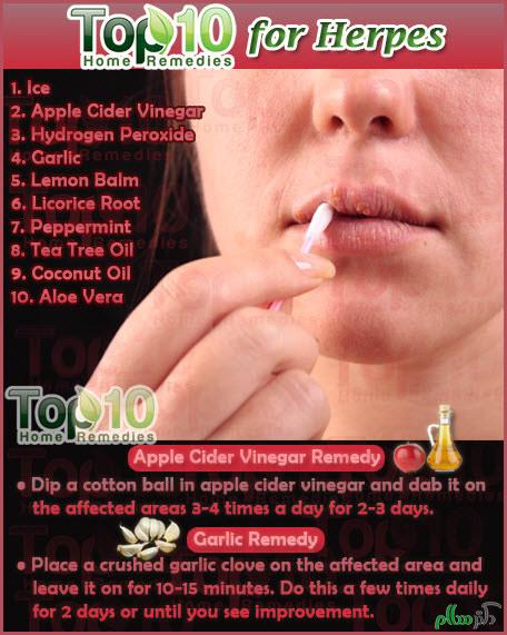 herpes-home-remedies-opt