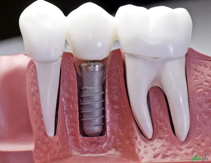 انواع پروتز دندانی و ایمپلنت را بهتر بشناسید