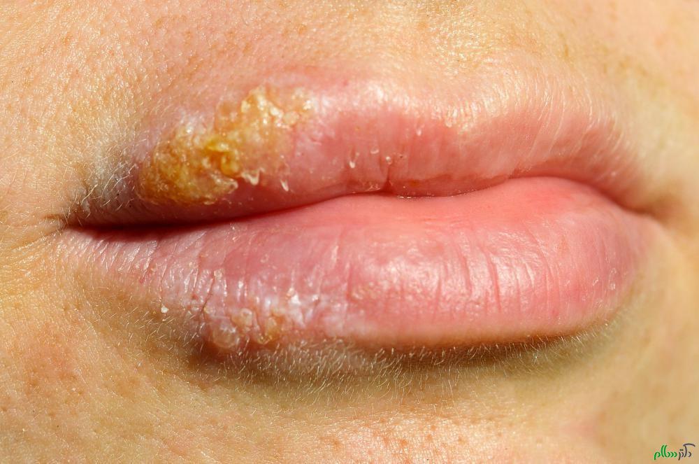 lips-with-herpes-sore