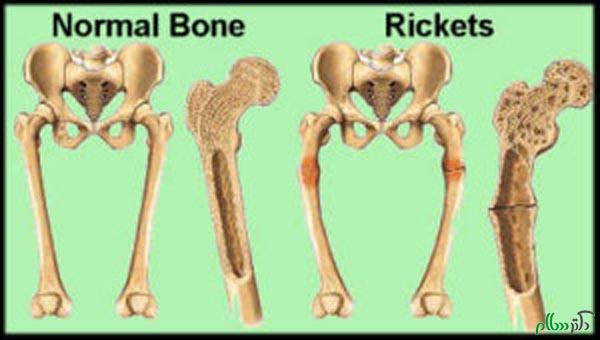 ricketsbone big