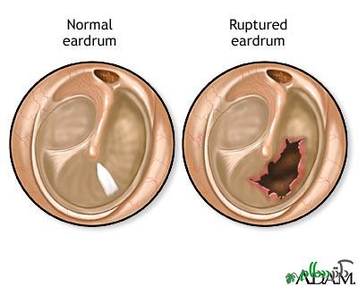 ruptured-eardrum