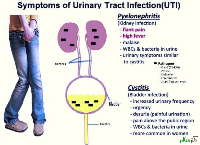 symptoms of UTI_cystitis