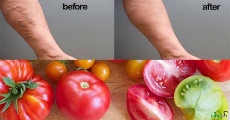 tomatoes-and-VARICOSE-VEINS