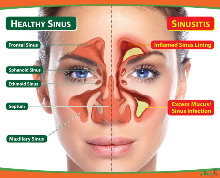 treat-sinusitis