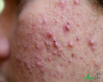 types-of-pimples-on-the-face