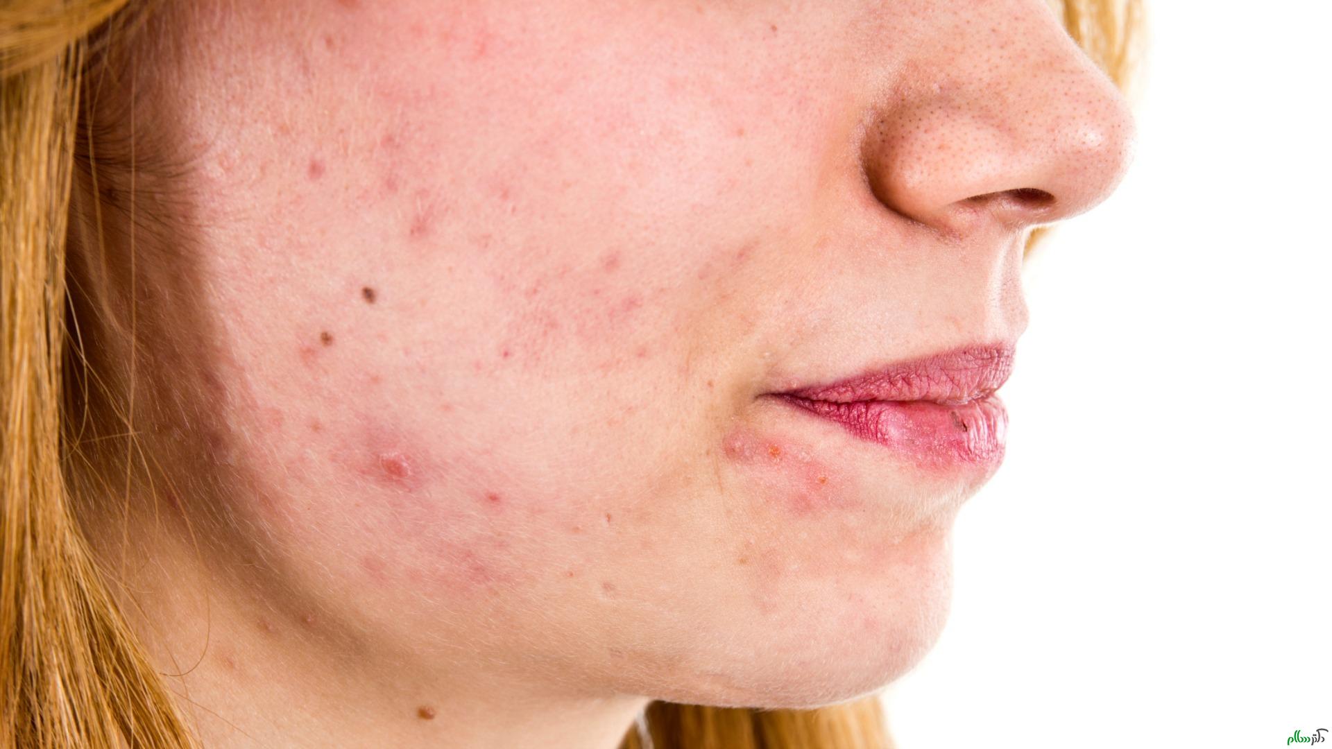 what-your-dermatologist-isnt-telling-you-about-acne