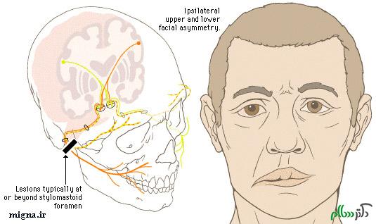 bells_palsy11