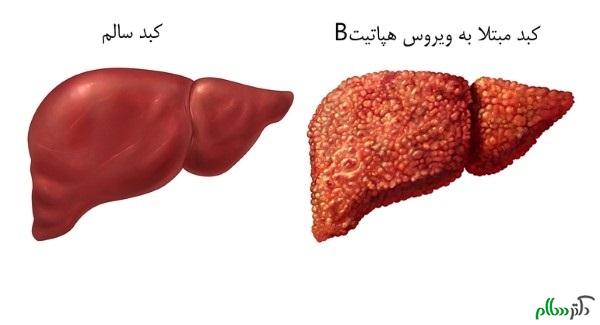 hepatitis-b-2