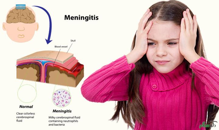 meningitis-in-children1