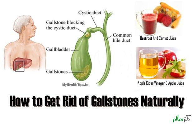 remedies-for-gallstones