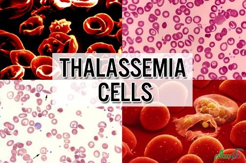 thalassemia-1