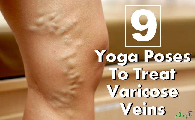 yoga-poses-to-treat-varicose-veins