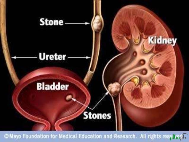 kidney-stone-14-638-jpg%253fcb%253d1414102929
