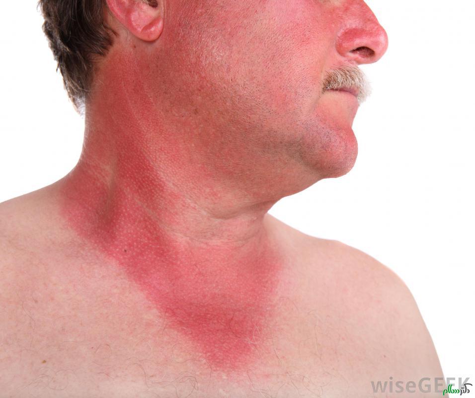man-with-sunburn-face-neck