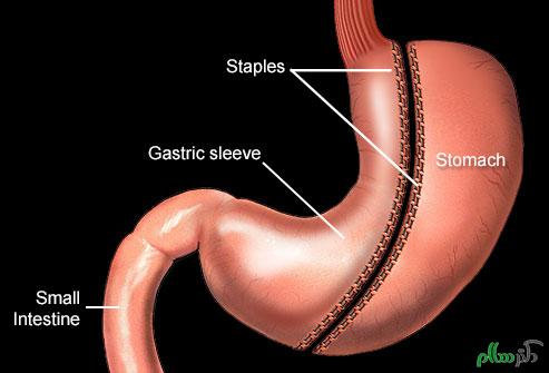 nucleus_rm_illustration_of_gastric_sleeve