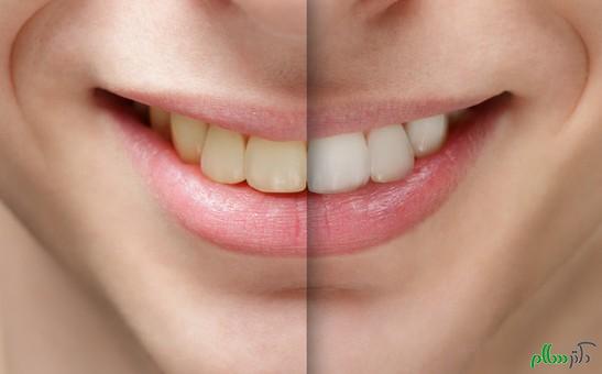 photodune-8854883-young-man-smile-before-and-after-teeth-whitening-xs-547x340