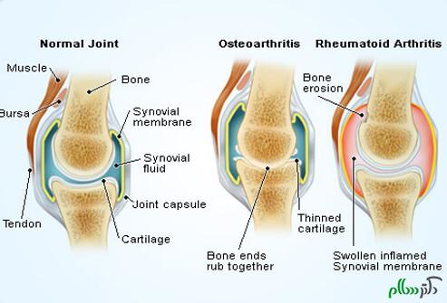rheumatoid_arthritis_s4_normal_affected_joints