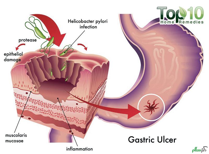 stomach-ulcer-gastric