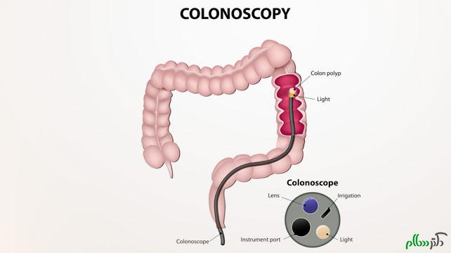030215_colonoscopy_alternatives-body