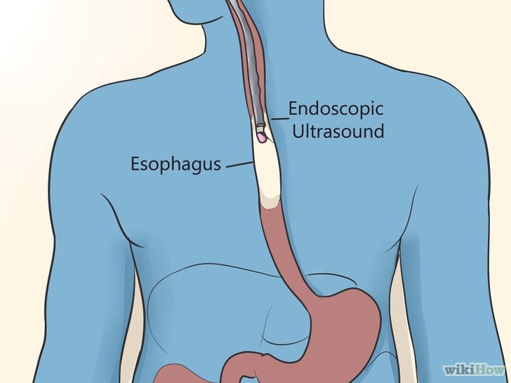 728px-diagnose-and-treat-esophageal-cancer-step-10