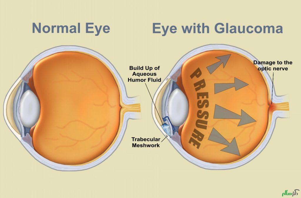 eye-with-glaucoma