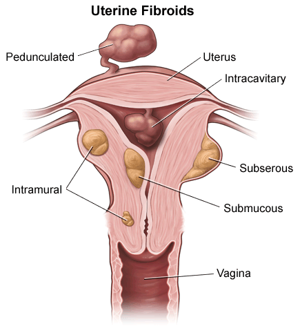 fibroids_illustration_ucla_lg