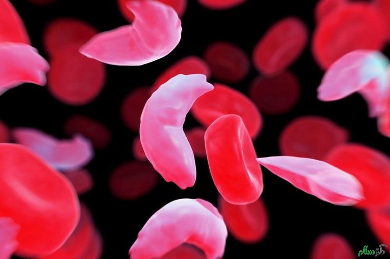 Sickle-cell-anemia