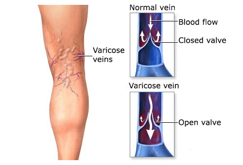 varicose-veins1-copy