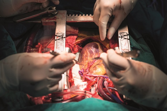 coronary-artery-bypass-grafting-16