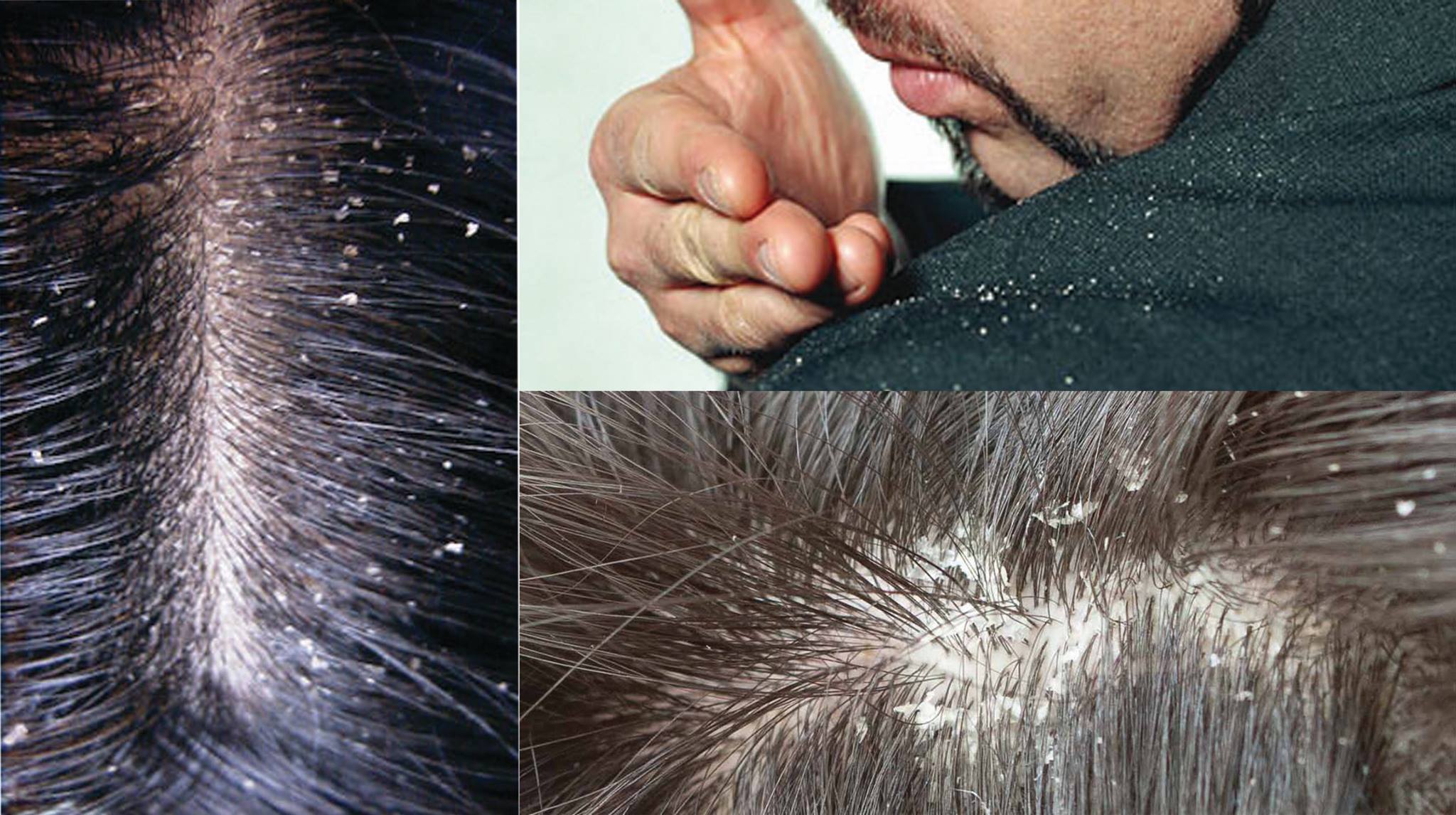 dandruff