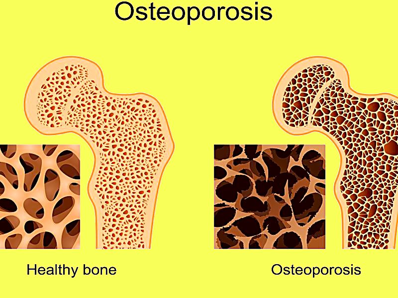 dt_160725_osteoporosis_800x600