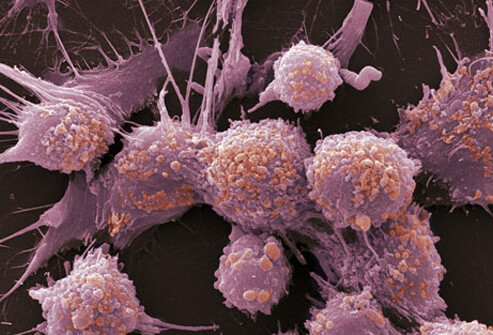 prostate-cancer-s20-photo-of-prostate-cancer-cells