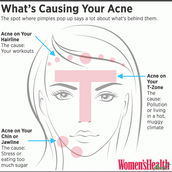 wh-acne-graphic_0