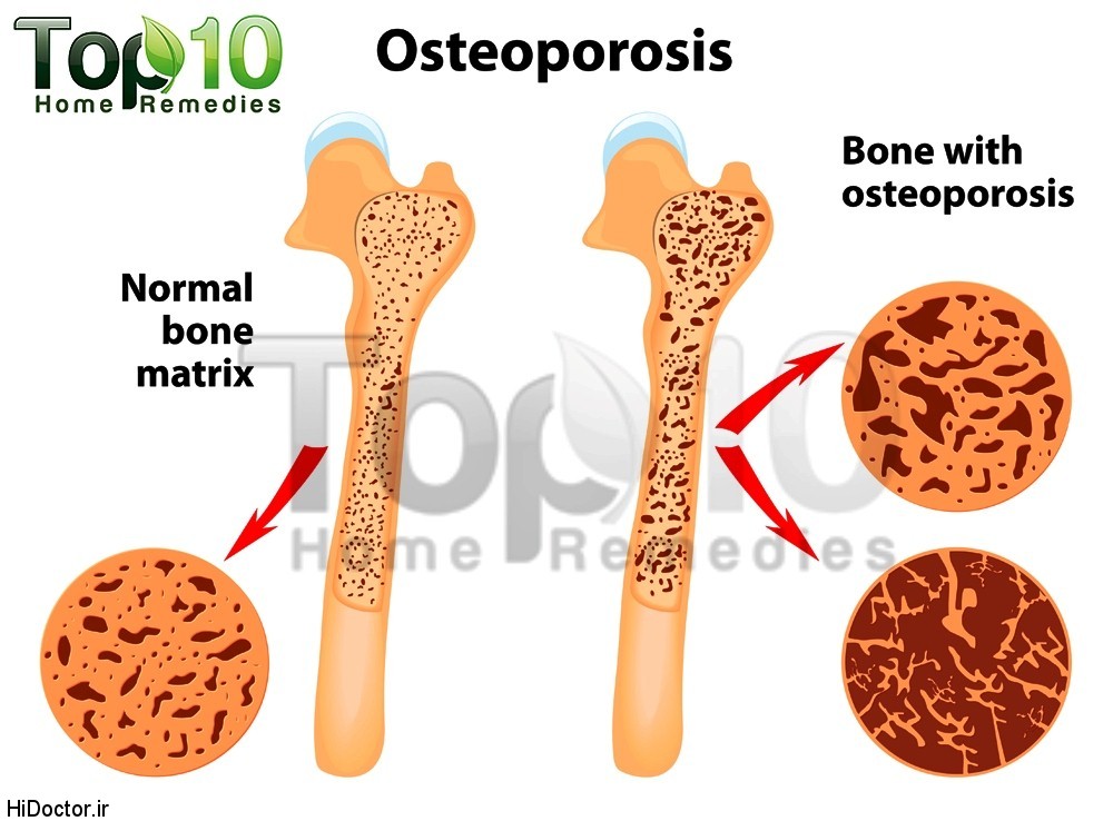 osteoporosis-illustration-opt