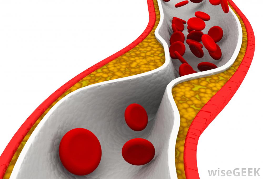 cholesterol-in-artery-wall