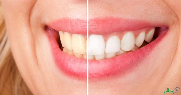 white-teeth-2